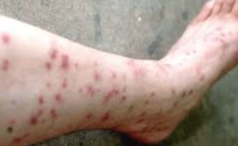 flea repellent humans